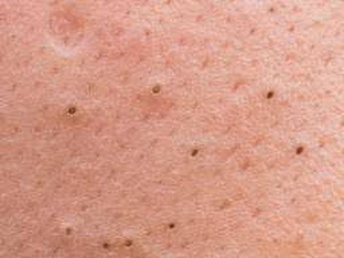Symptoms of black heads