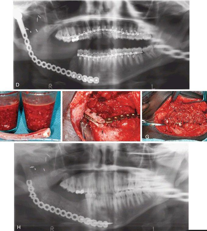 Bone plates in mandible