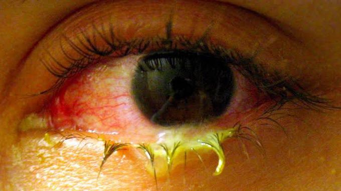 Conjunctivitis