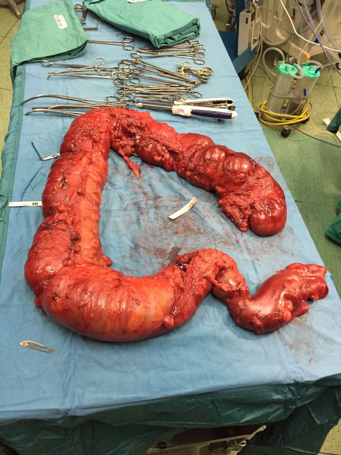 Megacolon Tossico