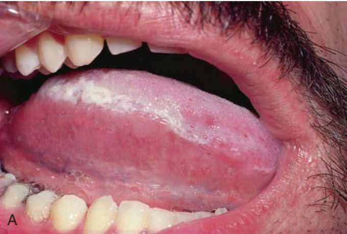 Hairy leukoplakia