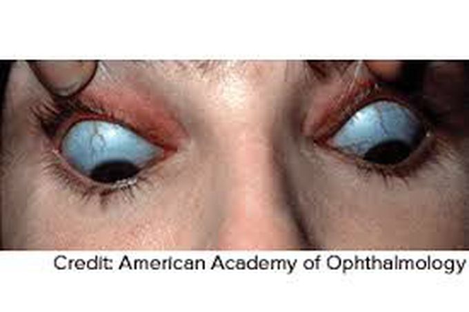 Prevention of blue sclera