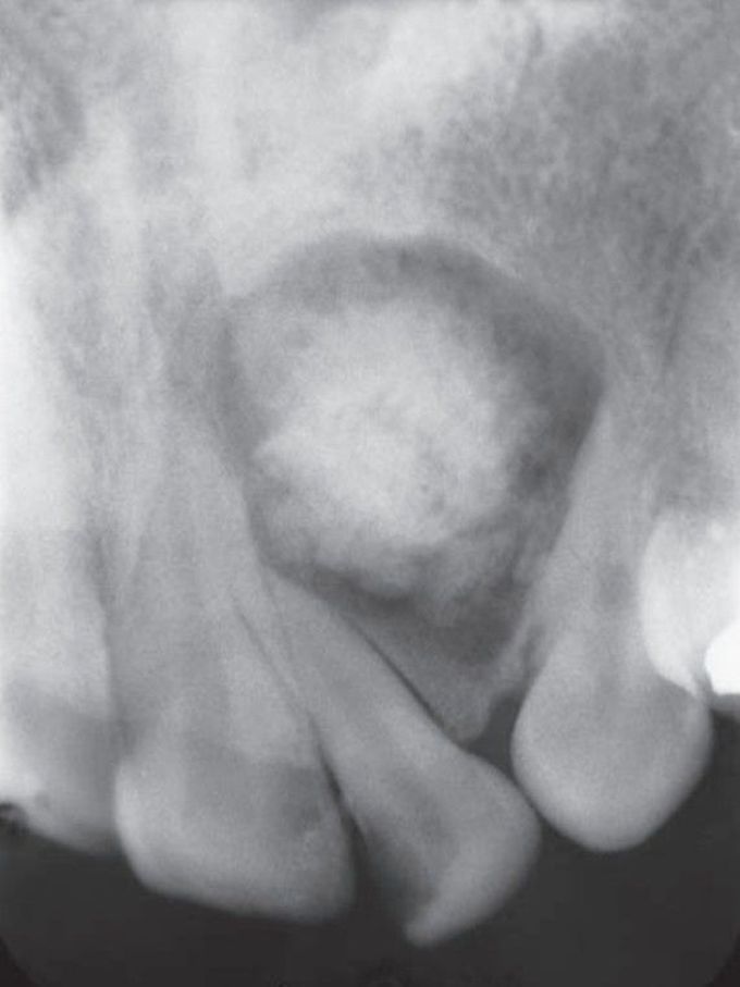 Calcifying odontogenic cyst - MEDizzy