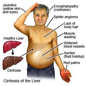 Cirrhosis of liver MEDizzy