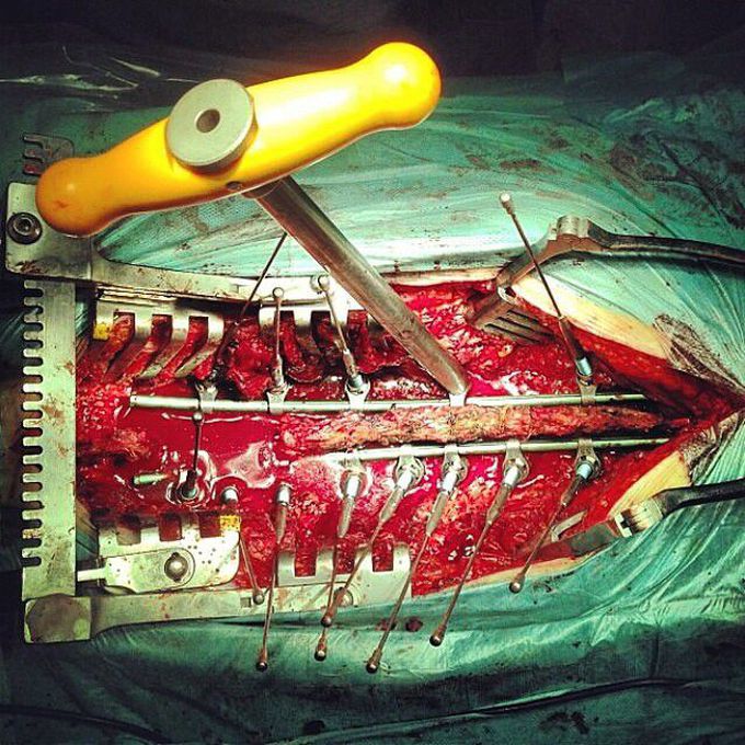 Spinal surgery in process