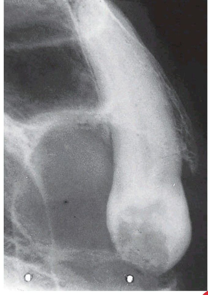 Resorption of tooth associated with a dentigerous cyst.