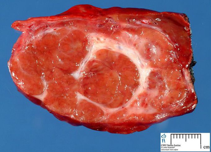 Liver tumor