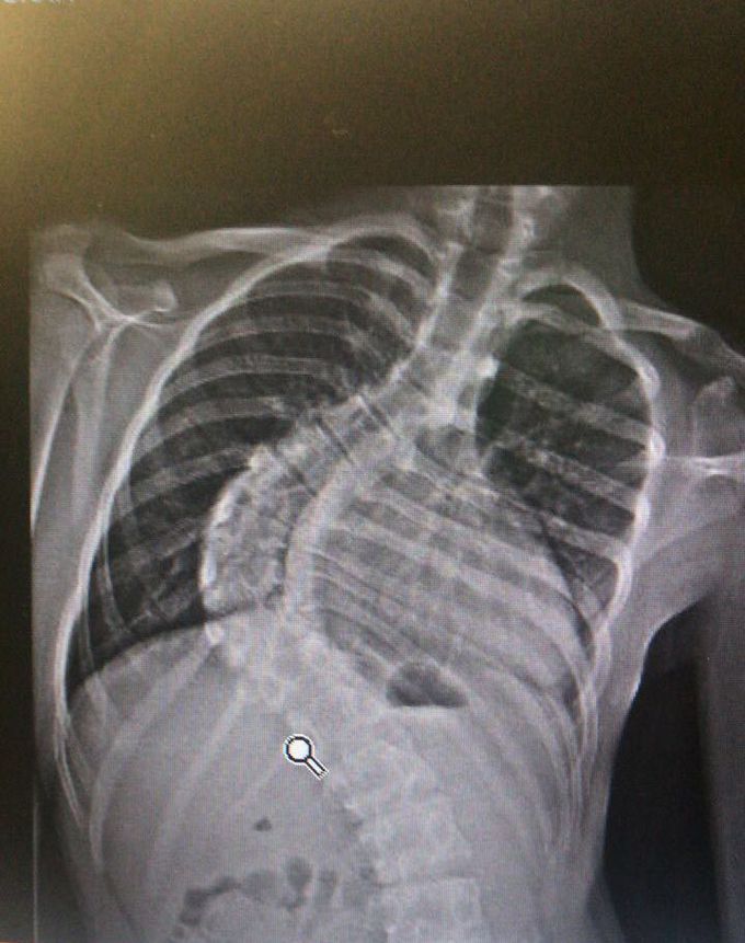 Scoliosis