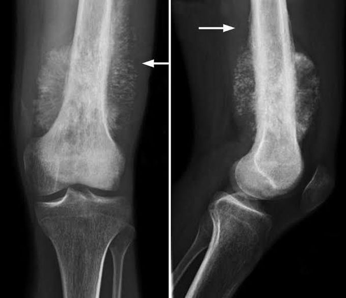 causes of osteosarcoma