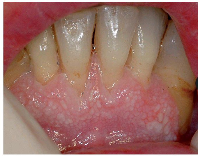 Speckled leukoplakia