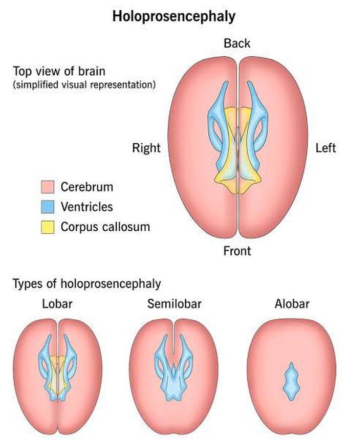 Holoprosencephaly