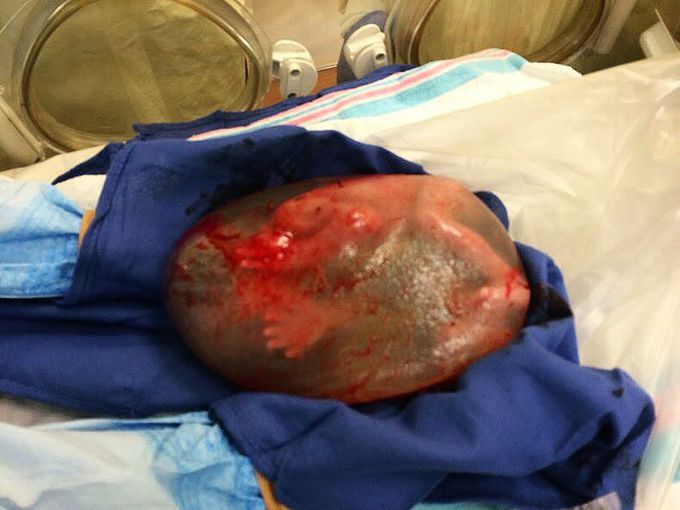 Premature baby still encased in an intact amniotic sac
