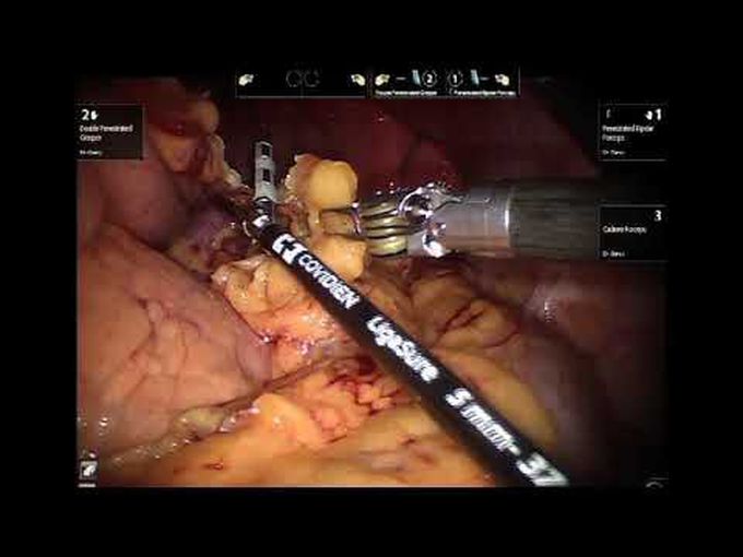 Pancreatic 
Resection