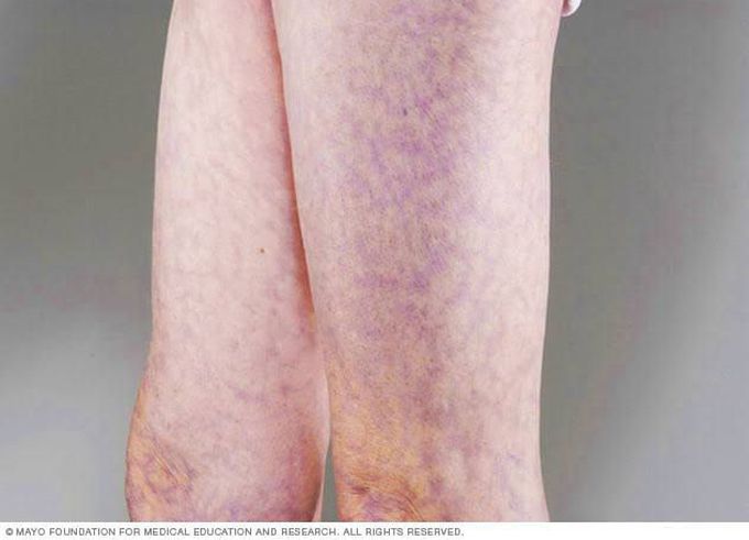 Livedo reticularis