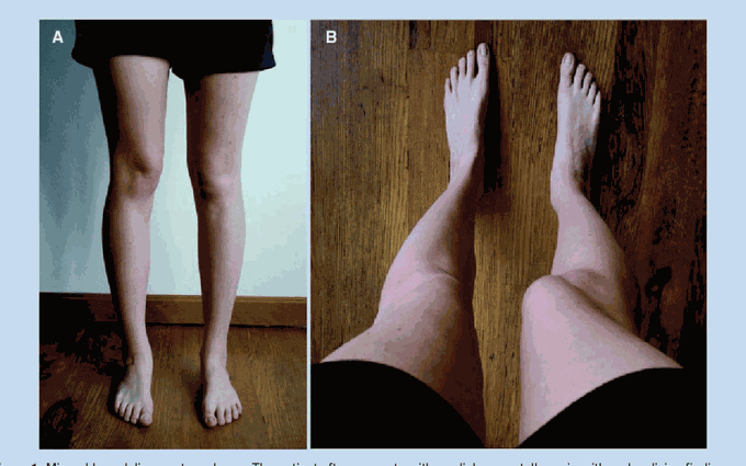 Symptoms of Patellar malalignment