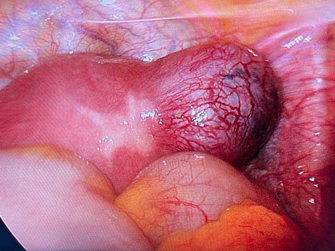 Ectopic pregnancy in laparoscopy