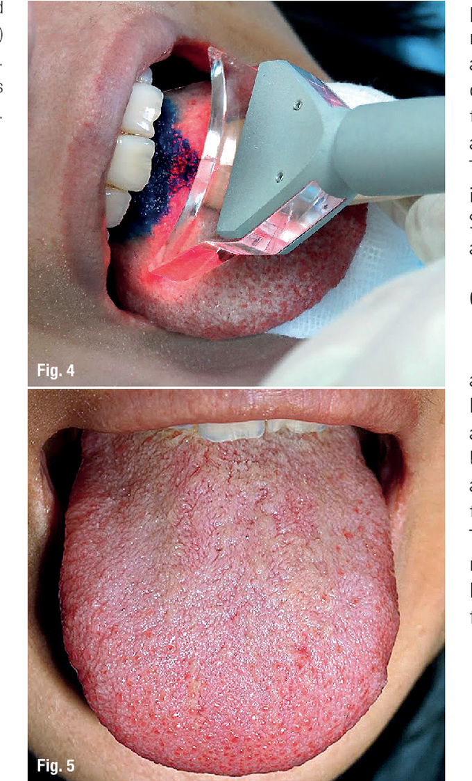 Treatment for Black Hairy tongue