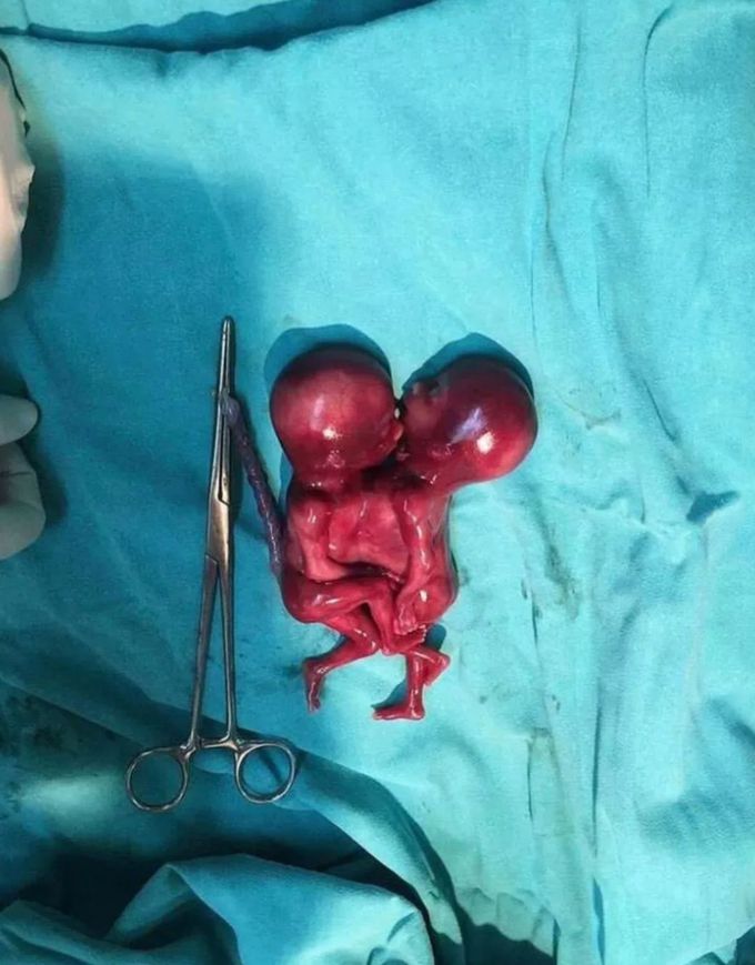 Two conjoined twins born in one heart❤️
