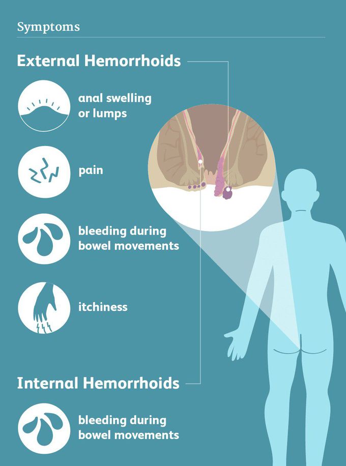 Symptoms of Hemorrhoids