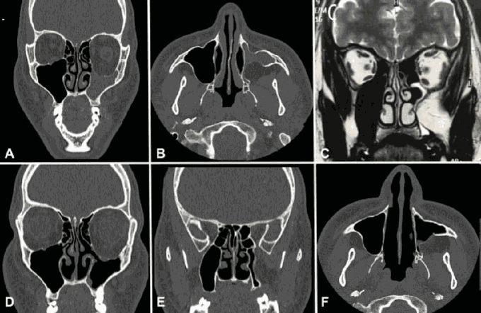 Silent Sinus Syndrome