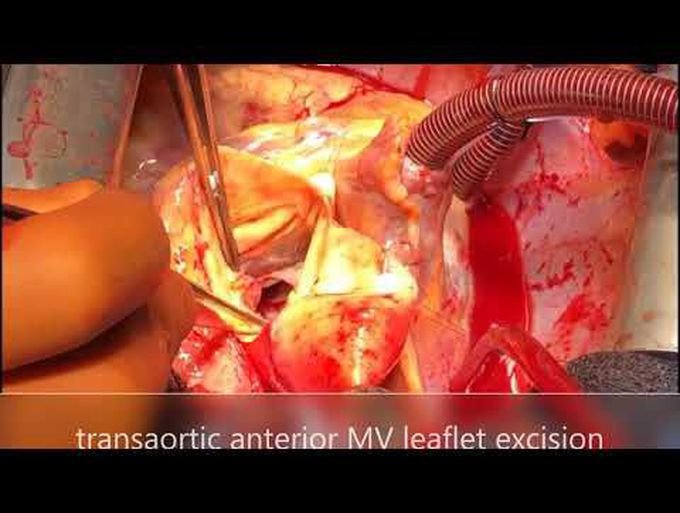 AVNeo™ (Ozaki) and Transaortic Mitral Valve Repair Using Autologous Pericardium