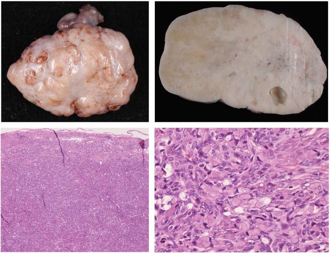 Krukenberg tumor