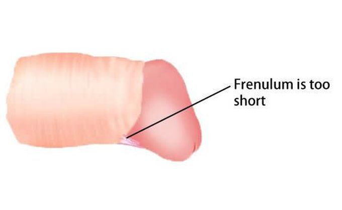 Sign and symptoms of frenulum breve