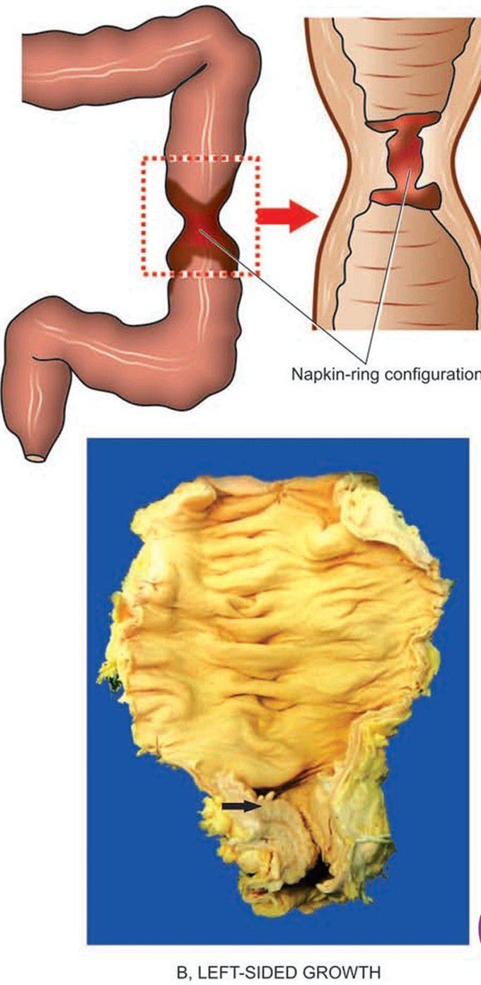 Gross appearance of colorectal carcinoma