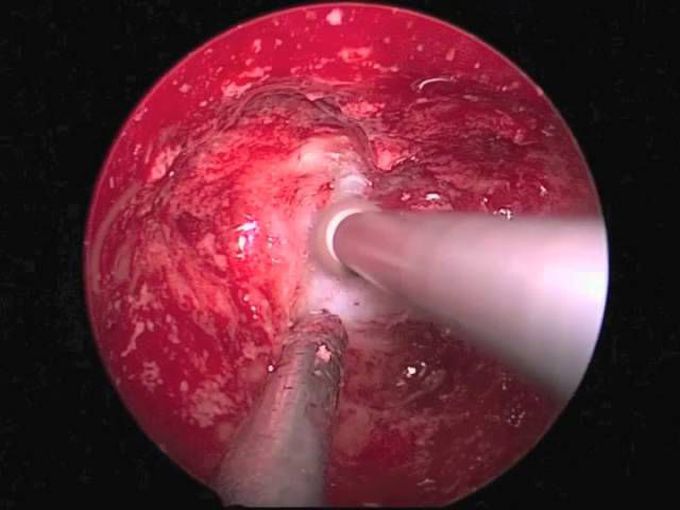 Surgical management of craniopharyngioma