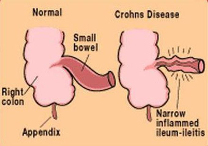 Cause of Crohn's disease