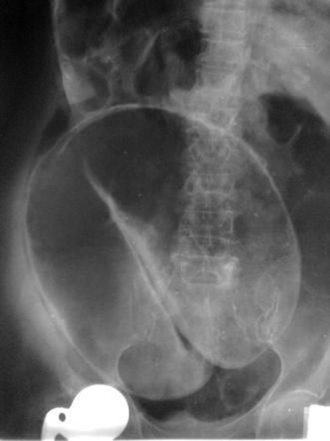 Coffee-Bean Sign on Xray