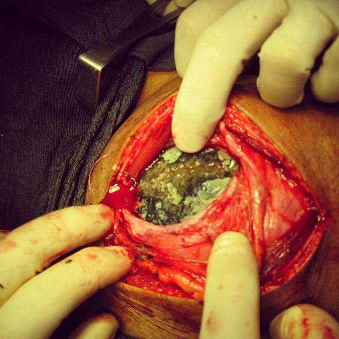 2KG stone in the bladder
