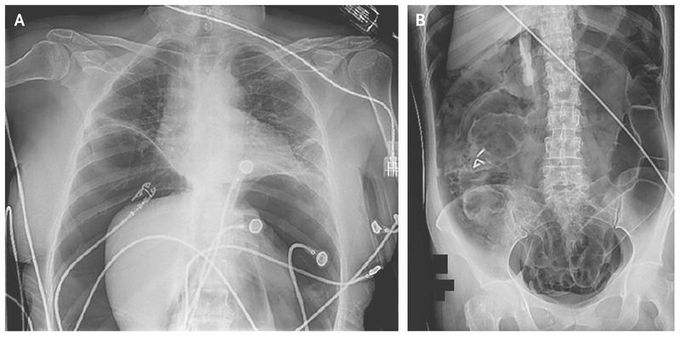 Tension Pneumoperitoneum