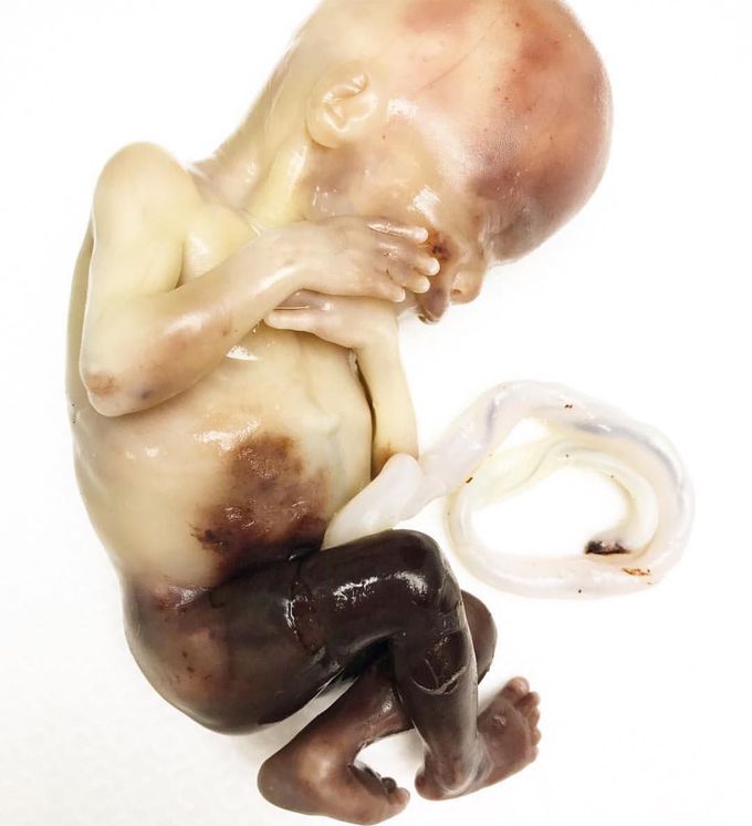 17-18 weeks fetus