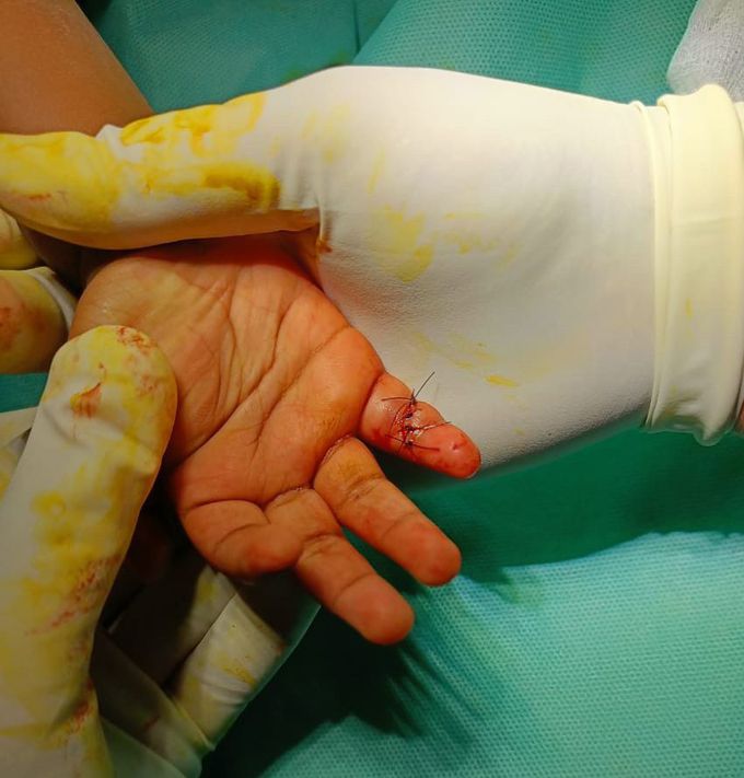 Suturing of CLW over the Volar aspect of right little finger