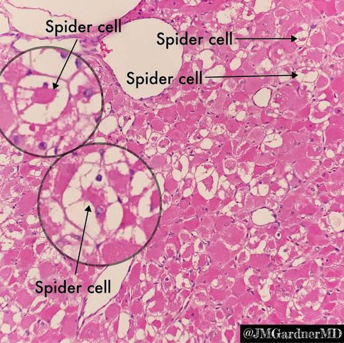 spider  cell  seen in ?