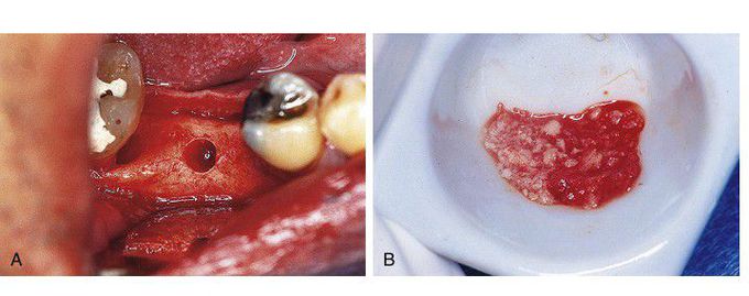 Bone grafts