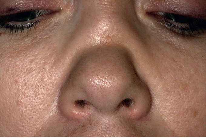 Oxycodone-related Saddle Nose Deformity.