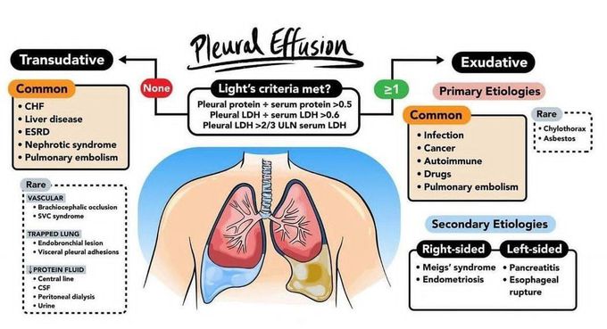 Pleural Effusion