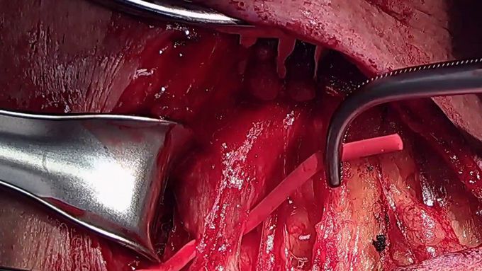 Left Carotid to Subclavian Artery Bypass