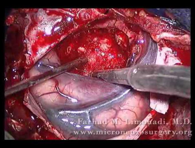 Careful removal of metastatic brain tumor (brain surgery)