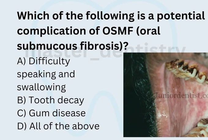 Complication of OSMF - MEDizzy