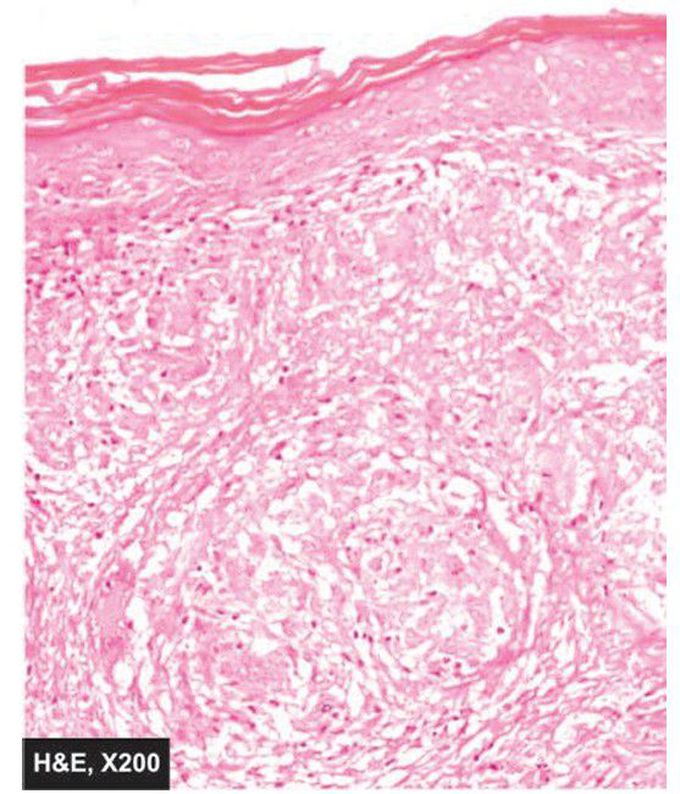 Cutaneous sarcoidosis.