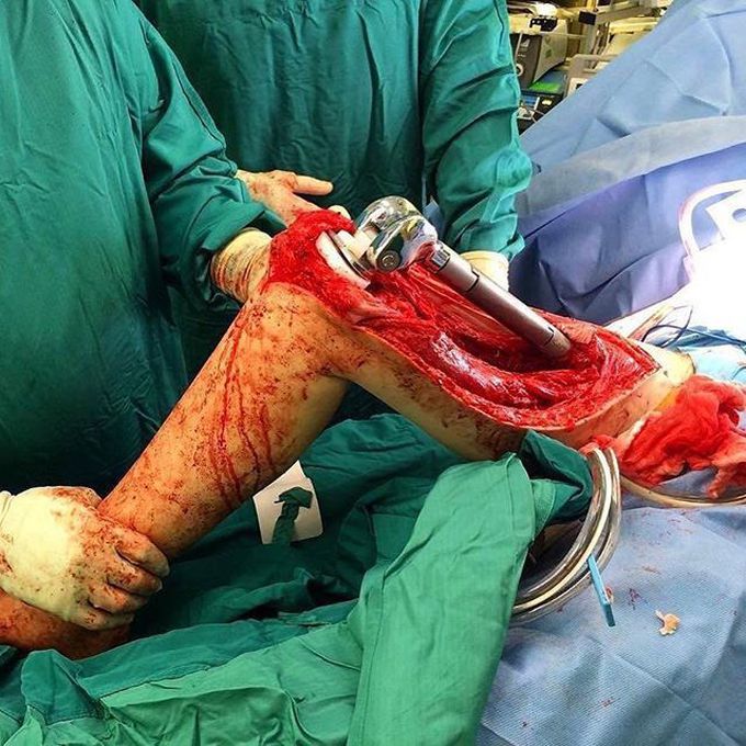 Total femur replacement surgery due to a chondrosarcoma - a metastatic bone cancer!