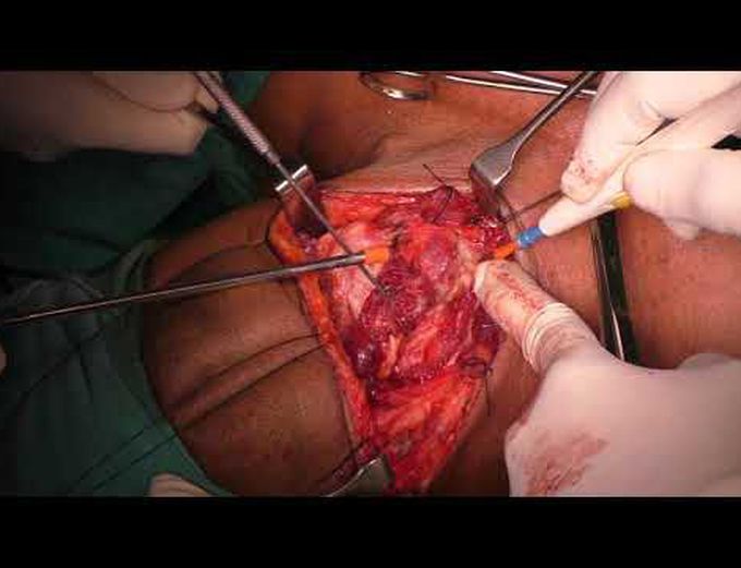 Supracricoid partial laryngectomy with chep