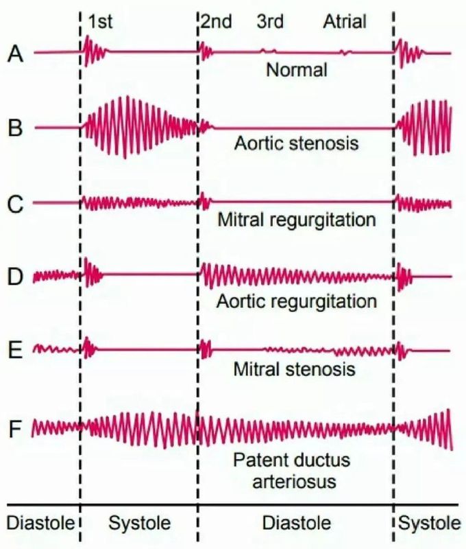 Phonocardiogram
