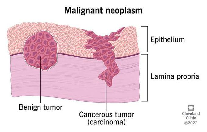 Neoplasms