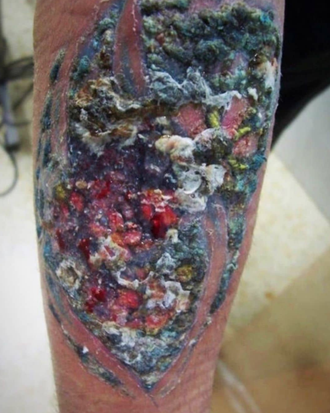 Tattoo infection!