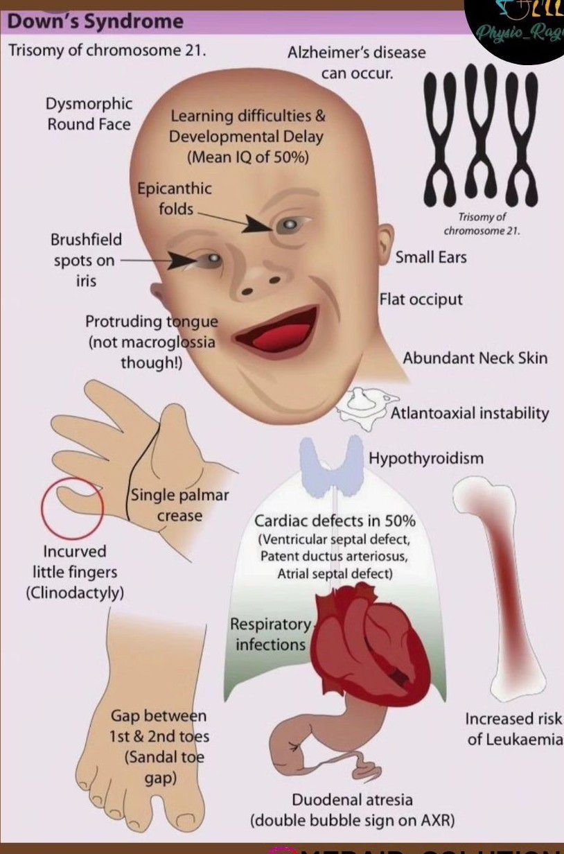 Down Syndrome - MEDizzy