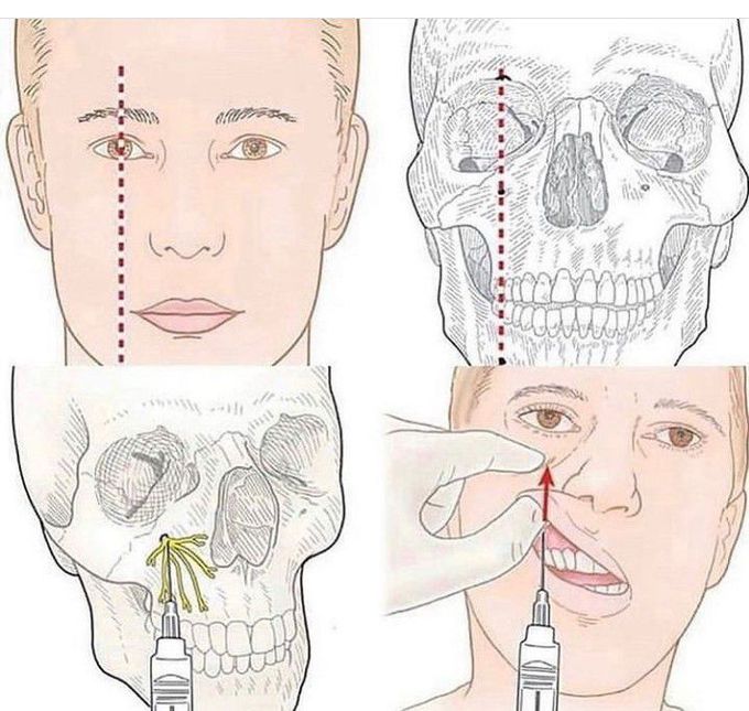 Infraorbital nerve block